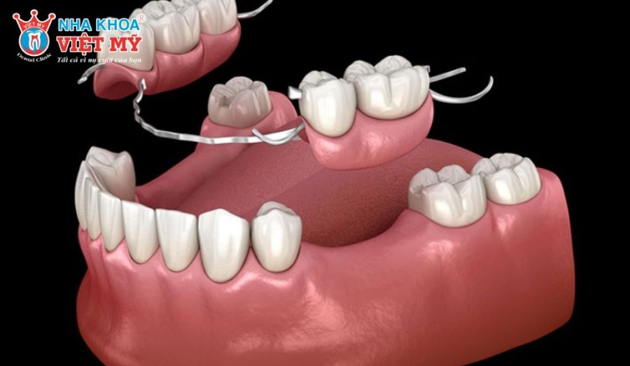 Hàm giả tháo lắp có chi phí thấp nhưng độ ổn định kém, không bảo tồn xương hàm và thường chỉ sử dụng hiệu quả trong 3–5 năm.