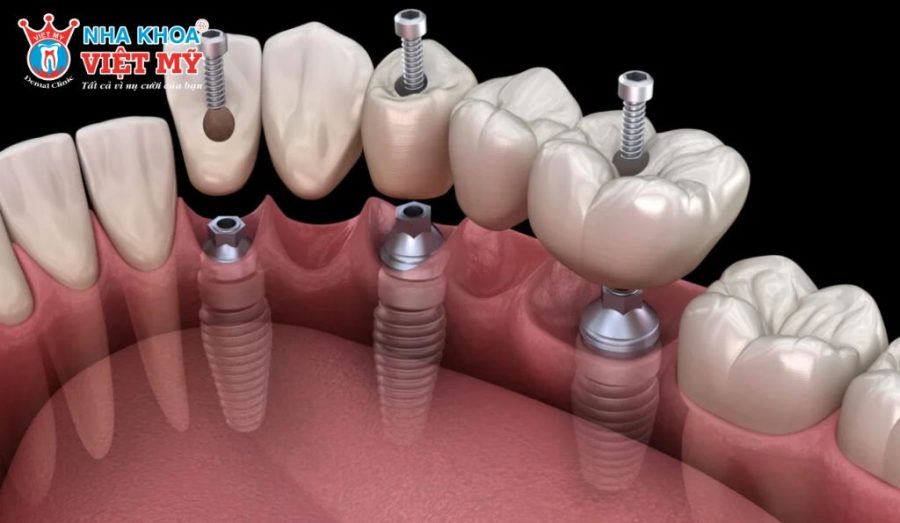 Răng Implant có thể sử dụng lâu dài nếu xương hàm tốt và được chăm sóc đúng cách