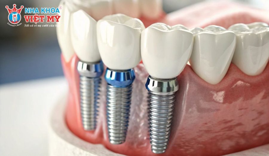 Độ bền vượt trội của răng Implant đến từ khả năng tích hợp xương sinh học, vật liệu tương thích cao và kỹ thuật cấy ghép chính xác.