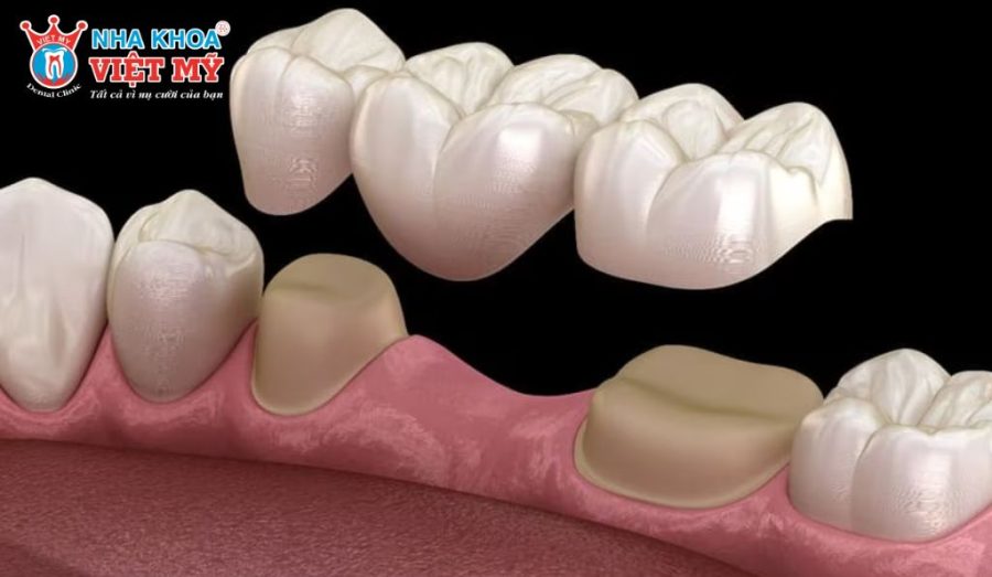 Cầu răng sứ cần mài răng kế cận nên tuổi thọ thường thấp hơn Implant