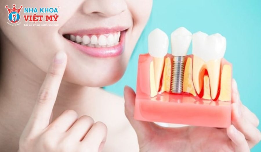 Chăm sóc răng miệng đúng cách và tái khám định kỳ giúp duy trì độ bền và ngăn ngừa biến chứng quanh Implant.
