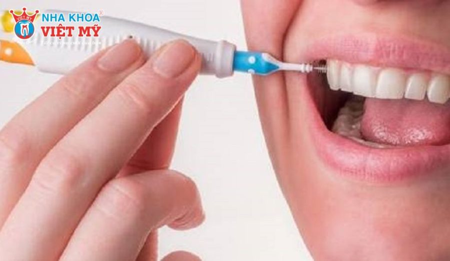 Vệ sinh đúng cách giúp răng Implant bền chắc và hạn chế biến chứng