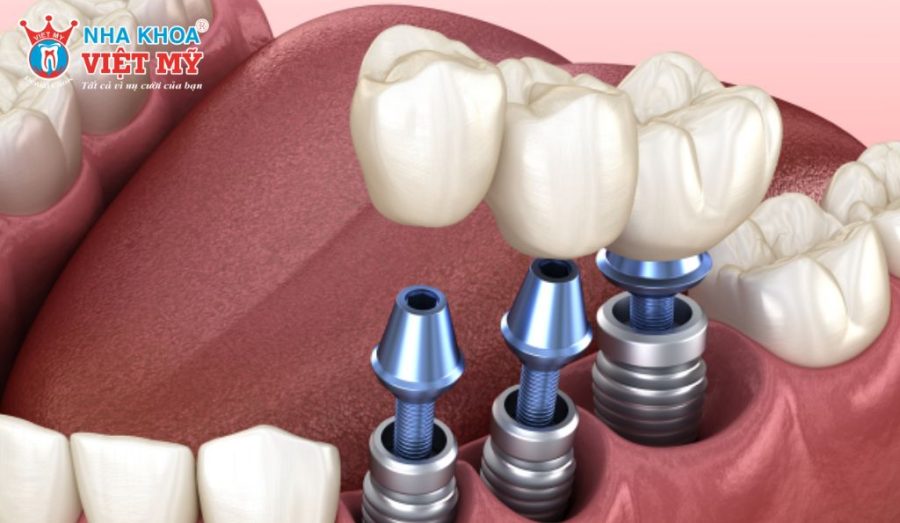 Răng Implant thay thế cả chân răng, giúp bảo tồn xương hàm và bền lâu