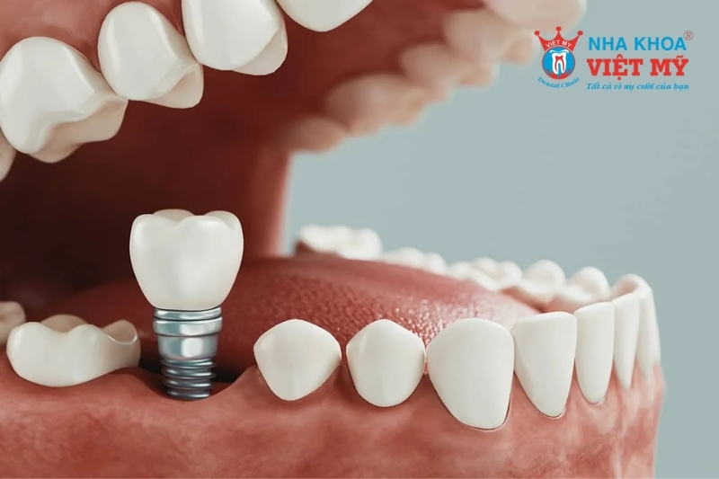 trồng răng implant phương pháp khôi phục tốt nhất hiện nay