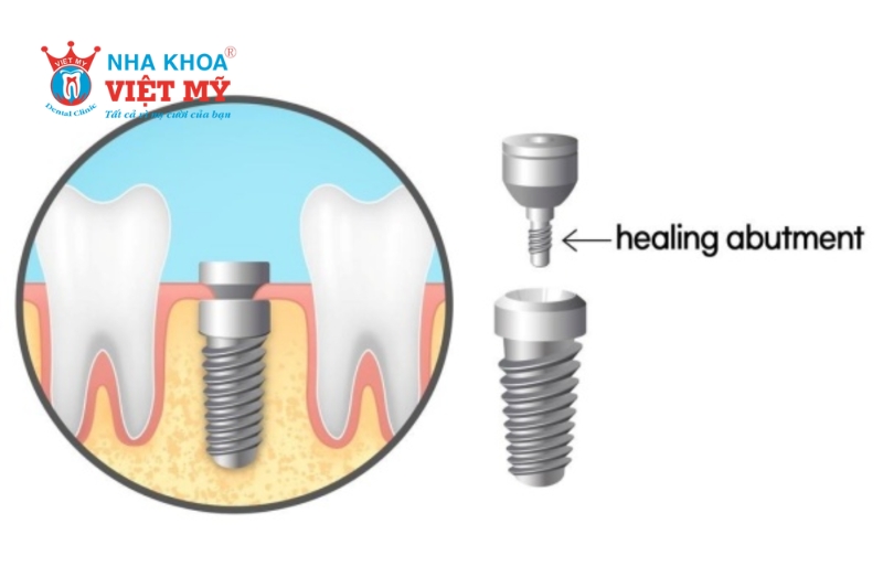 Trụ lành thương gắn trên implant