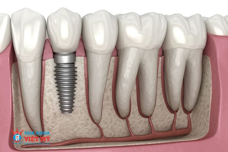 tình trạng răng miệng ảnh hưởng đến trồng răng implant