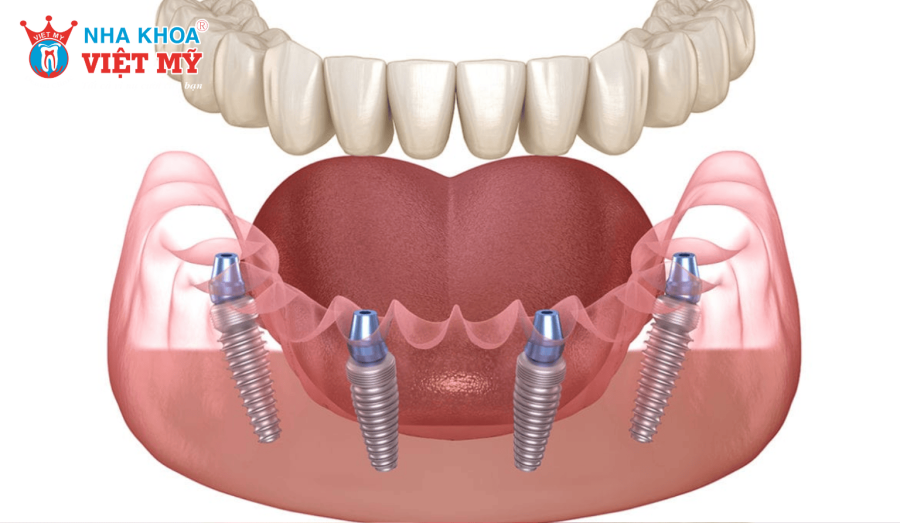 Người mất răng toàn hàm nên cấy ghép Implant