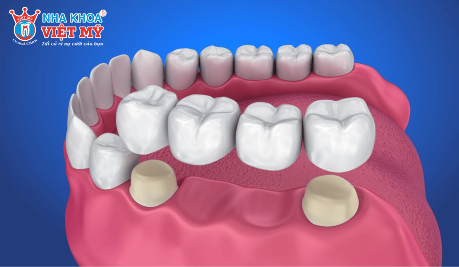 Cầu răng sứ là gì?