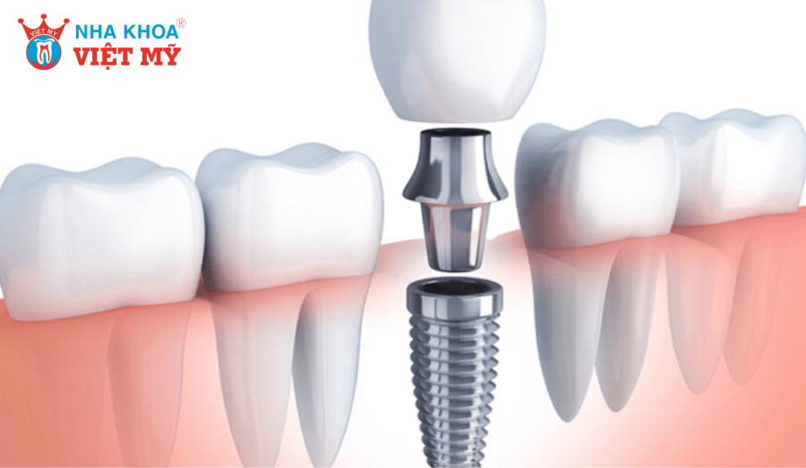 Cấy ghép Implant là gì?