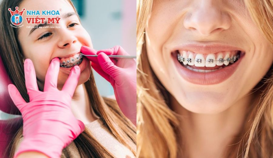 Hiệu quả điều trị phụ thuộc vào độ tuổi, mức độ lệch răng và cấu trúc xương hàm