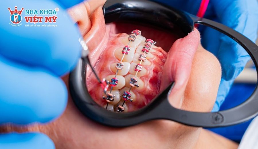 Từ khoảng 50 tuổi, răng và xương hàm thoái hóa, răng di chuyển chậm và hiệu quả chỉnh nha giảm