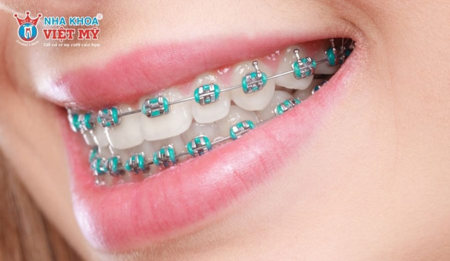 Độ tuổi ảnh hưởng trực tiếp đến chi phí niềng răng do khác biệt về can thiệp, thời gian và phương pháp điều trị