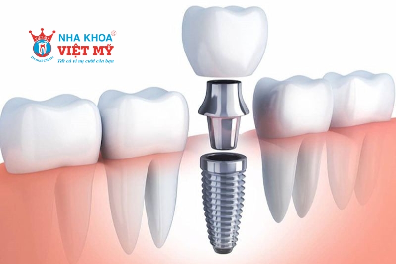 gắn mão sứ lên trụ implant khi phục hình rắng sứ