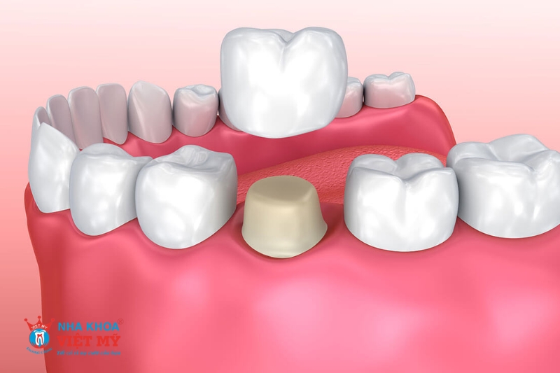 lưu ý một số điều khi gắn răng tạm