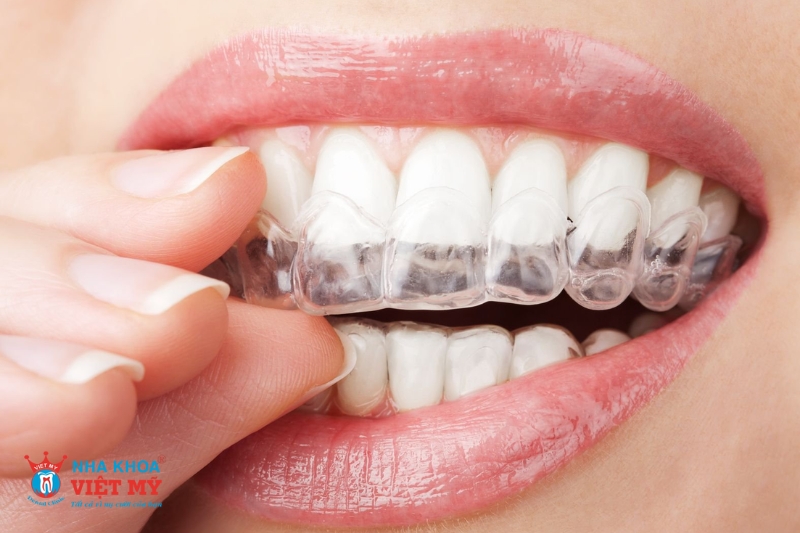 Niềng răng trong suốt Invisalign