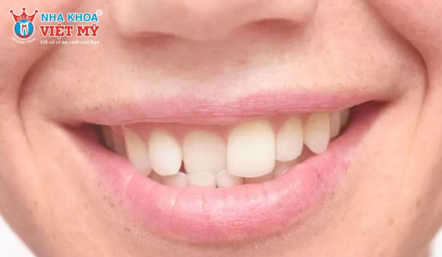 Niềng răng 1 hàm thường áp dụng cho răng lệch nhẹ, sai khớp cắn đơn giản và cần được bác sĩ thăm khám kỹ lưỡng