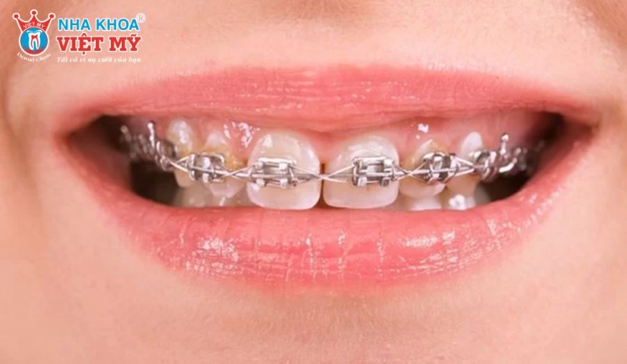 Thời gian niềng răng 1 hàm thường ngắn hơn niềng 2 hàm, trung bình từ 6-12 tháng.