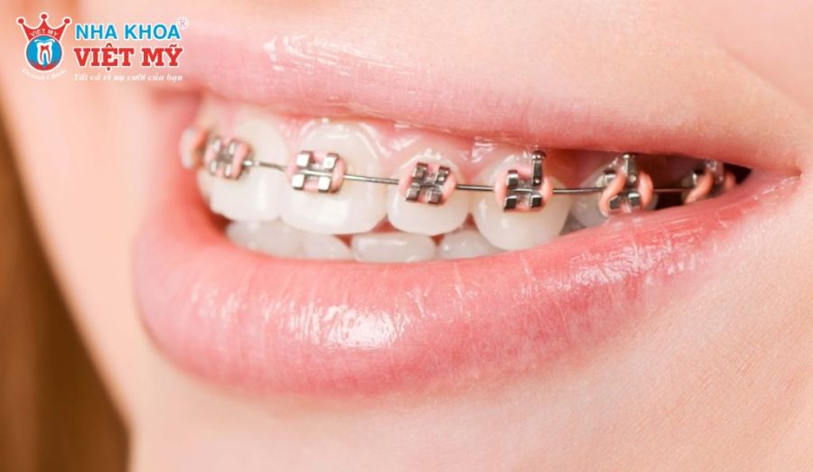 Chi phí niềng răng 1 hàm phụ thuộc vào phương pháp chỉnh nha và tình trạng răng cụ thể.