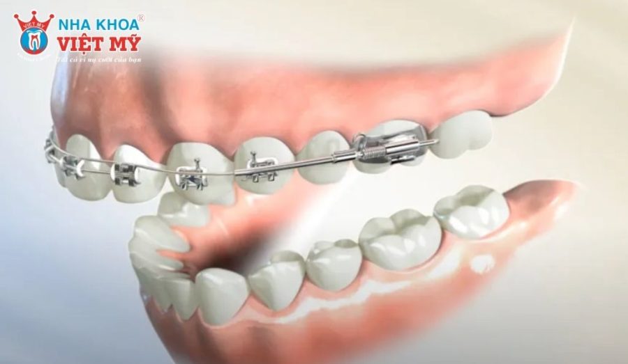 Niềng răng 1 hàm là phương pháp chỉnh nha chỉ tác động lên hàm trên hoặc hàm dưới theo chỉ định của bác sĩ.