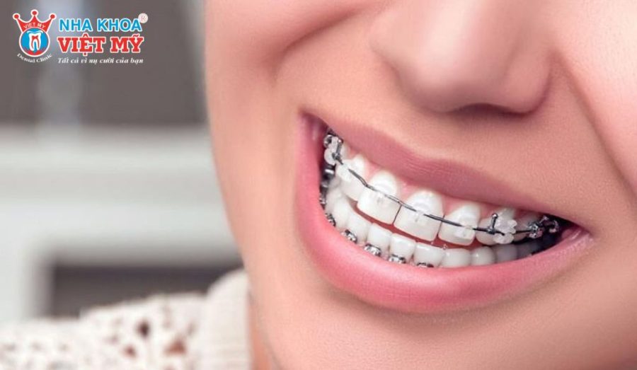 Niềng răng 1 hàm bằng mắc cài giúp kiểm soát lực kéo tốt, phù hợp với các trường hợp răng lệch từ trung bình đến phức tạp.
