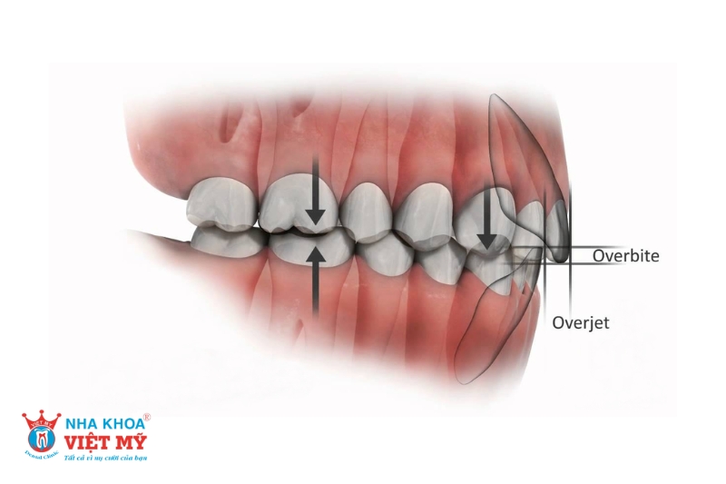 nguyên nhân niềng răng bị hở lợi