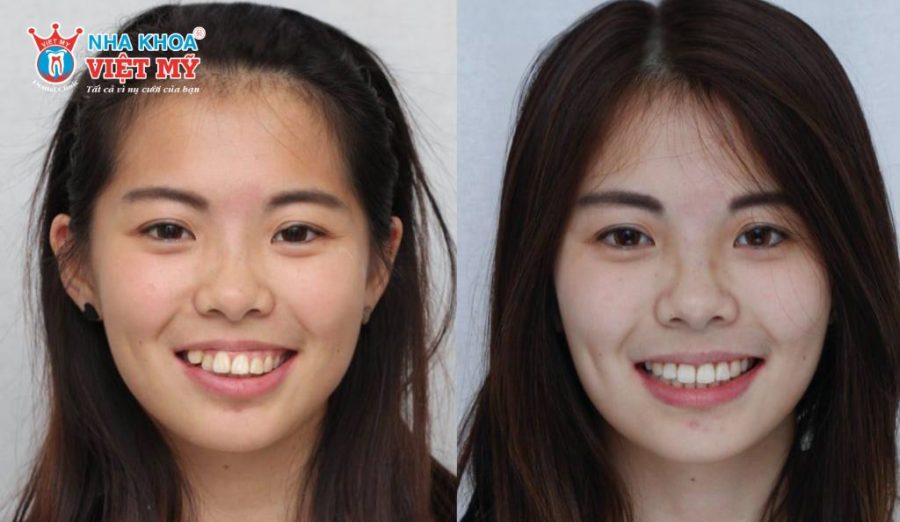 Sự thay đổi khuôn mặt trước và sau rõ rệt khi niềng răng hàm hô