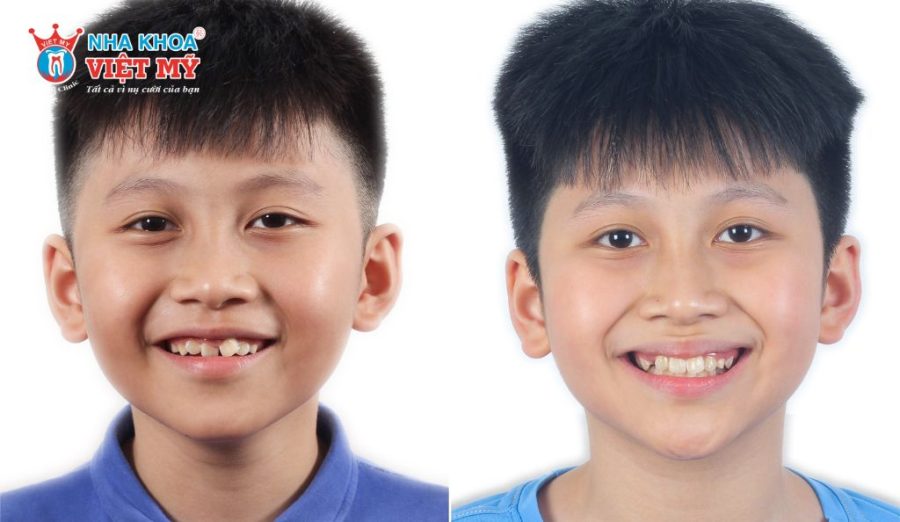 Sau niềng răng, khuôn mặt trẻ cân đối hơn, hàm phát triển ổn định và nụ cười đều đẹp tự nhiên