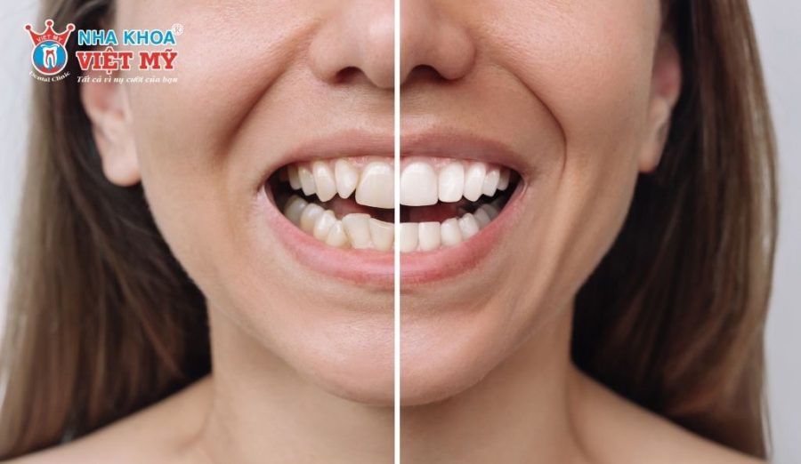 Răng lệch nhẹ, khớp cắn gần chuẩn nên khuôn mặt sau niềng thay đổi không đáng kể