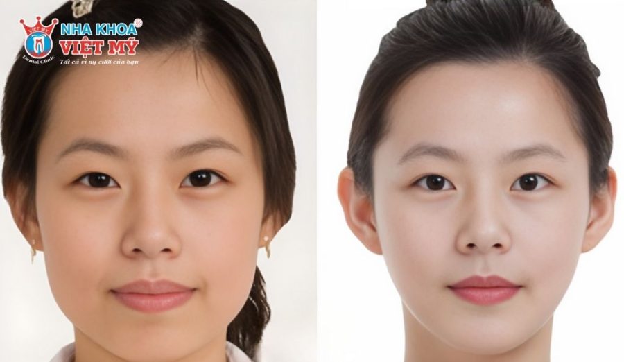 Niềng răng không chỉ giúp răng đều đẹp mà còn góp phần cải thiện khuôn mặt ở nhiều khía cạnh