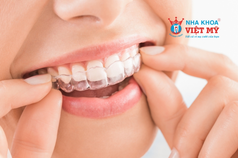 Nhiều trường hợp hiệu quả khi chọn niềng răng invisalign