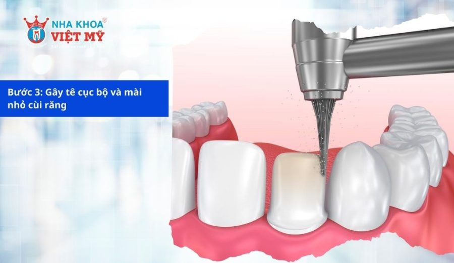 Mài nhỏ cùi răng để tiến hành gắn mão sứ vào răng sâu Mài nhỏ cùi răng để tiến hành gắn mão sứ vào răng sâu