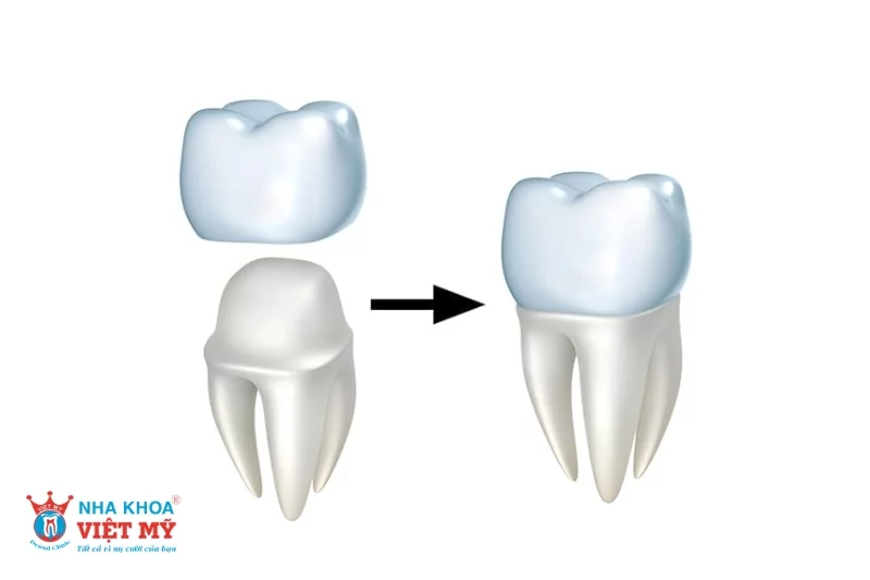 Chăm sóc đúng cách để ngăn ngừa sâu răng sau khi bọc sứ