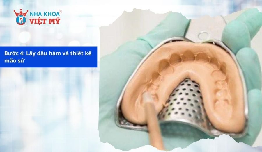 Lấy dấu hàm và thiết kế mão sứ