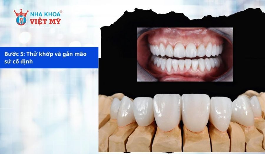 Thử khớp và gắn mão sứ cố định