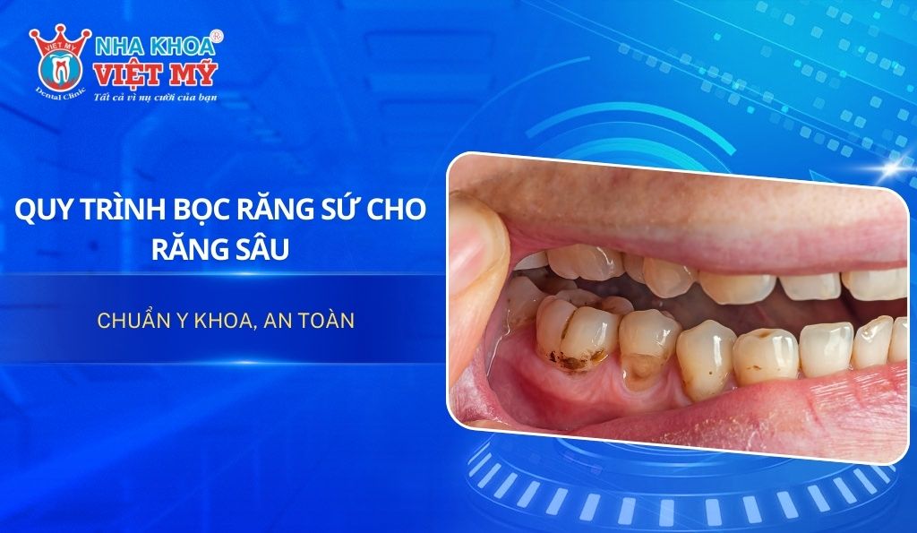 thumbnail quy trình bọc răng sứ cho răng sâu