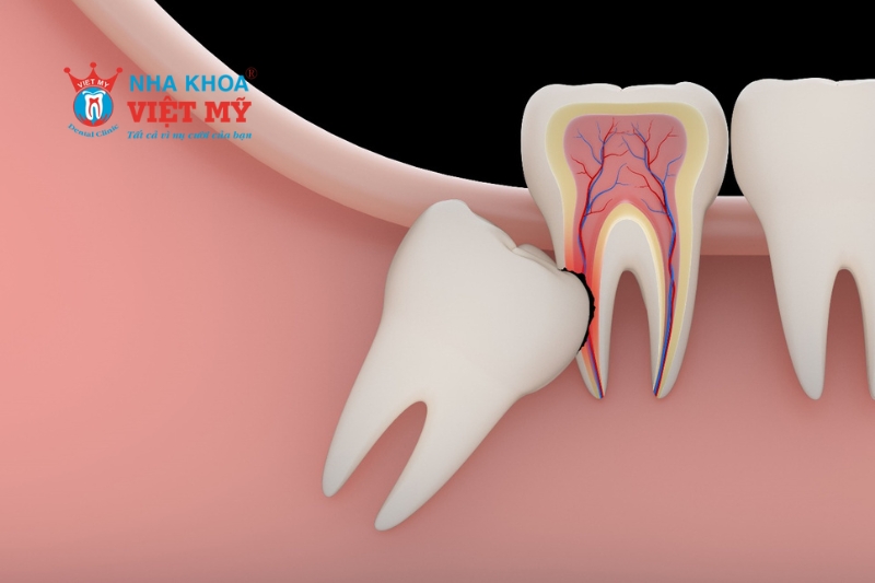 Răng mọc lệch làm tổn thương các răng kế cạnh