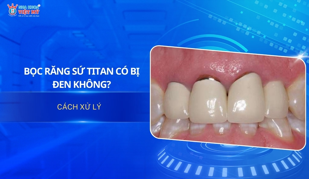 thumbnail bọc răng sứ Titan có bị đen không