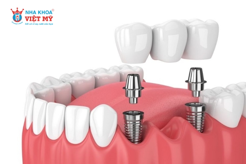 trồng răng implant mất bao lâu