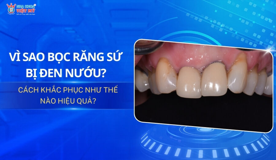 thumbnail vì sao bọc răng sứ bị đen nướu