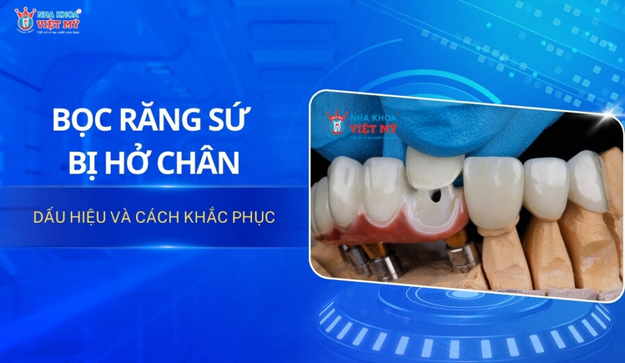 thumbnail bọc răng sứ bị hở chân