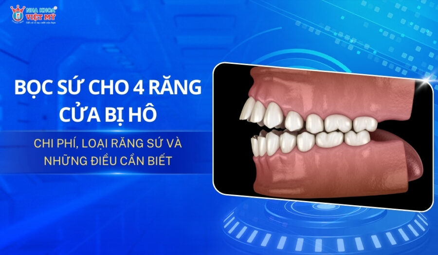 thumbnail bọc sứ cho 4 răng cửa bị hô