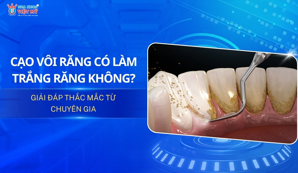 thumbnail cạo vôi răng có làm trắng răng không