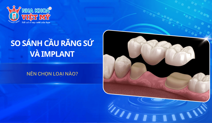 Cầu răng sứ và Implant là 2 phương pháp phục hình răng mất phổ biến. Nên chọn giải pháp nào để tối ưu chi phí và độ bền? So sánh chi tiết tại đây.