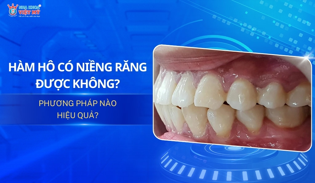 thumbnail hàm hô có niềng răng được không