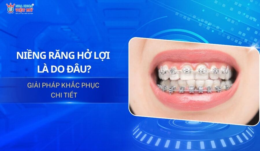 thumbnail niềng răng hở lợi là do đâu