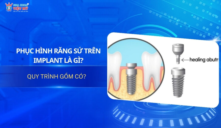 thumbnail phục hình răng sứ trên Implant