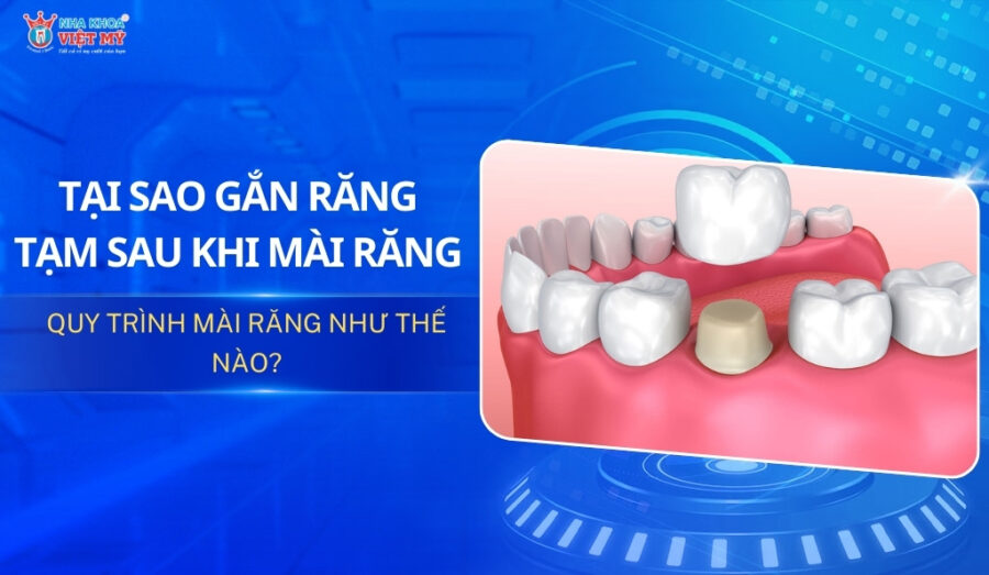 thumbnail gắn răng tạm sau khi mài