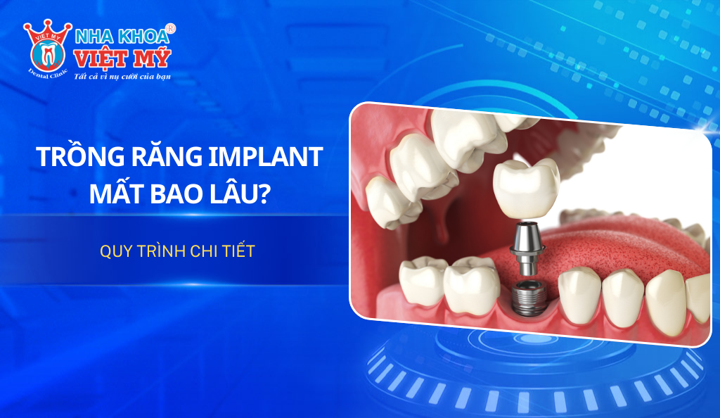 Trồng răng Implant mất bao lâu? Quy trình chi tiết