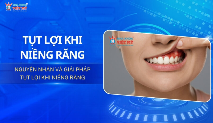 thumbnail tụt lợi khi niềng răng