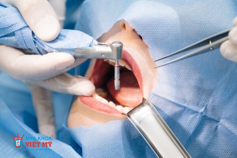 trình độ chuyên môn của bác sĩ ảnh hưởng đến thời gian trồng răng implant